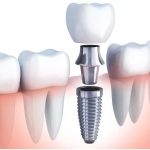 DENTAL IMPLANTS