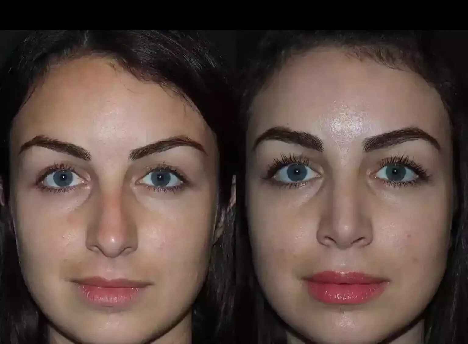 H-Rhinoplasty-15 (1)