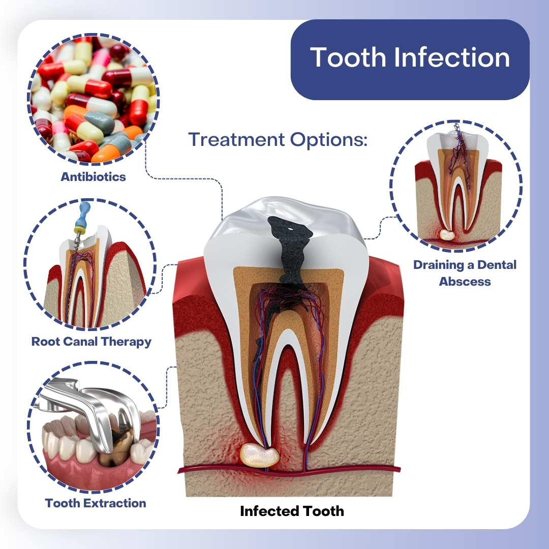 tooth-infection-treatment