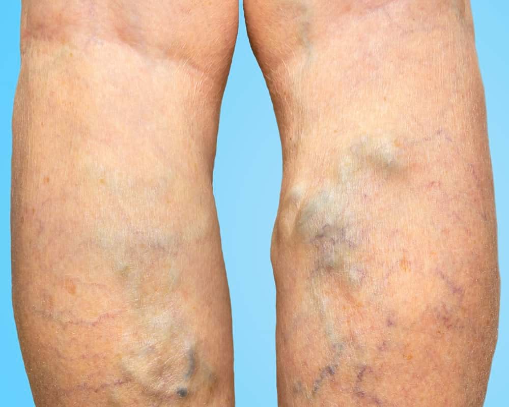 vericose veins 1