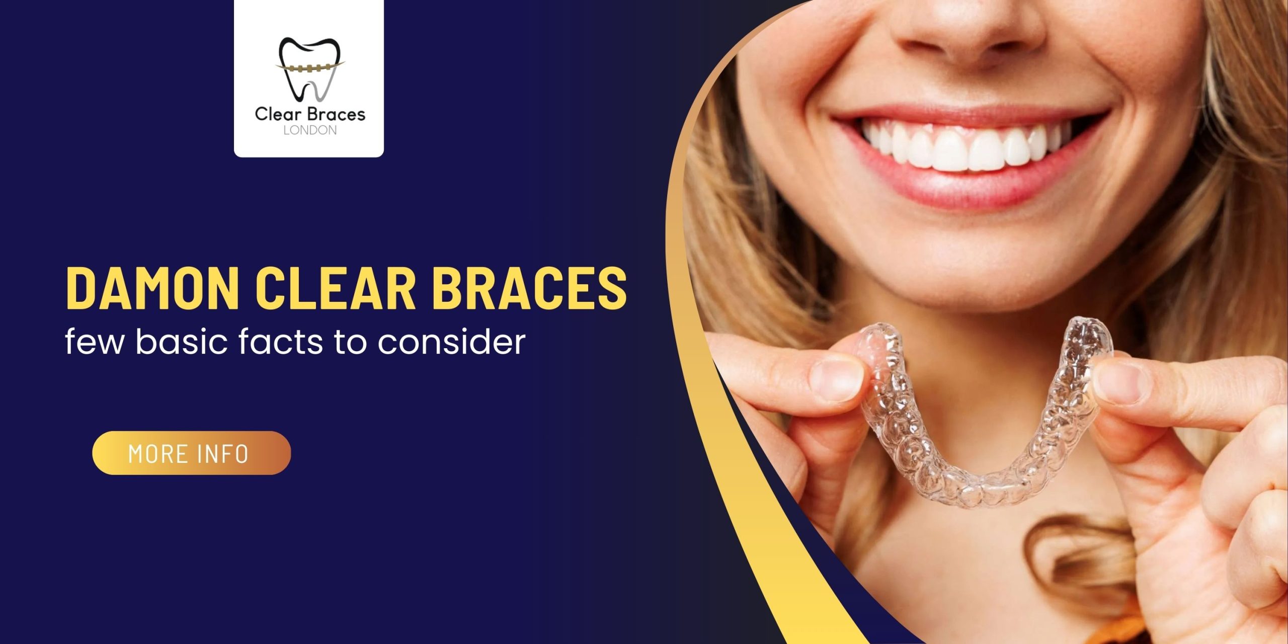Damon clear braces – few basic facts to consider