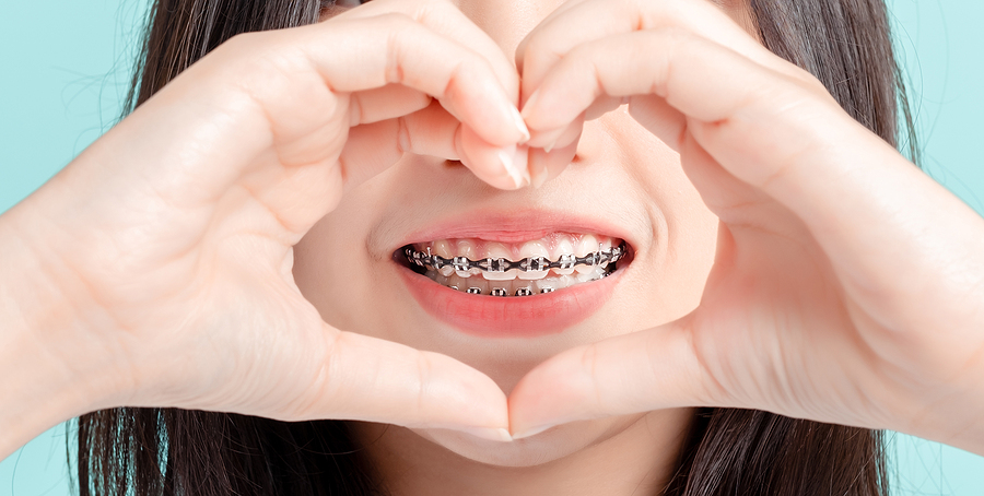 Dental Braces in Islamabad