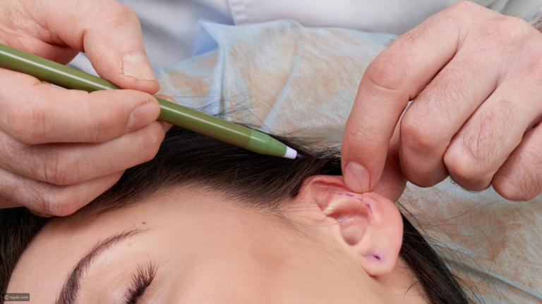 Ear Reshaping in Islamabad2