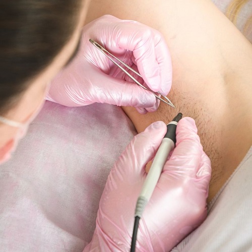 Electrolysis Laser Hair Removal