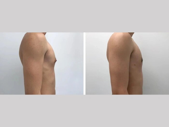 gynecomastia surgery in dubai
