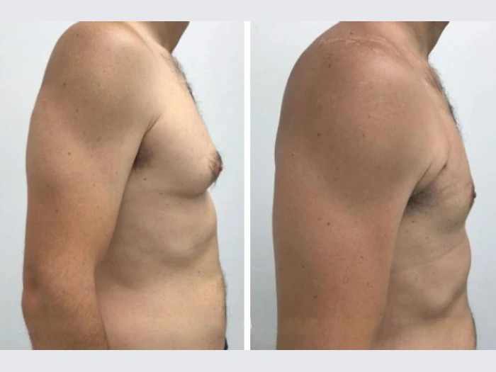 gynecomastia surgery in dubai