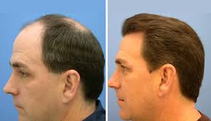 Hair transplant in Dubai (3)