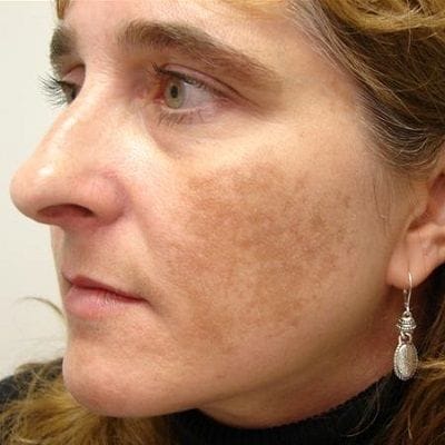 Melasma Treatment in Dubai5