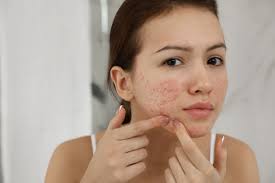 Pimples treatment in Dubai 1