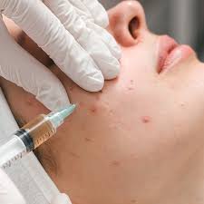 Pimples treatment in Dubai 2