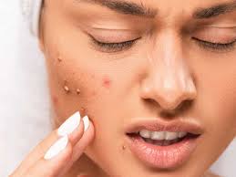 Pimples treatment in Dubai 3