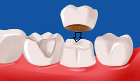 Teeth Crown Services