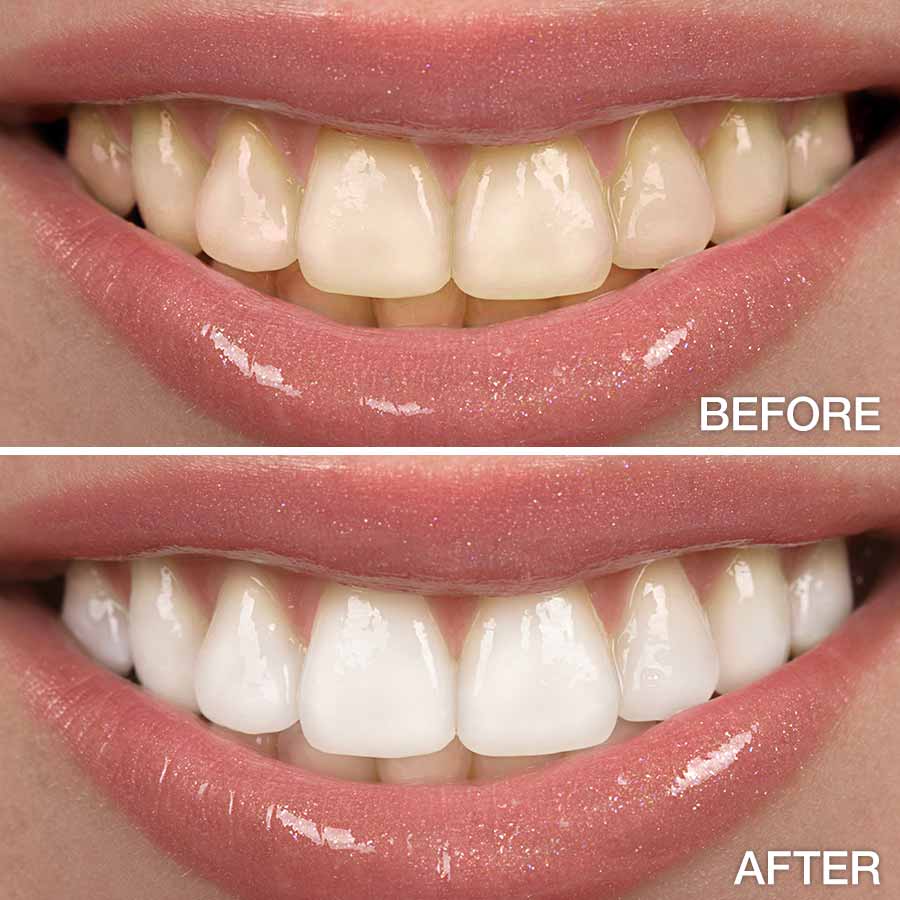 Teeth Whitening Cost in Dubai6