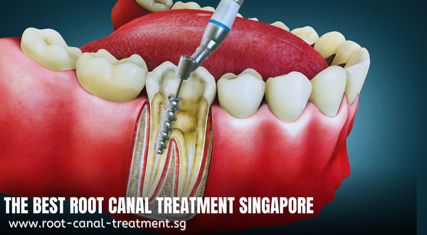 The Best root canal treatment Singapore