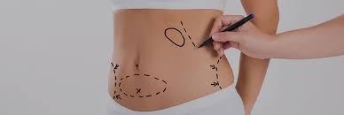 Tummy tuck..