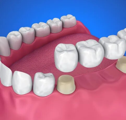 dental-crowns-and-bridges-1