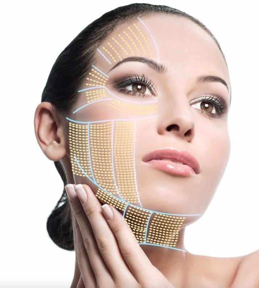 smasHIFU Treatment in Islamabad