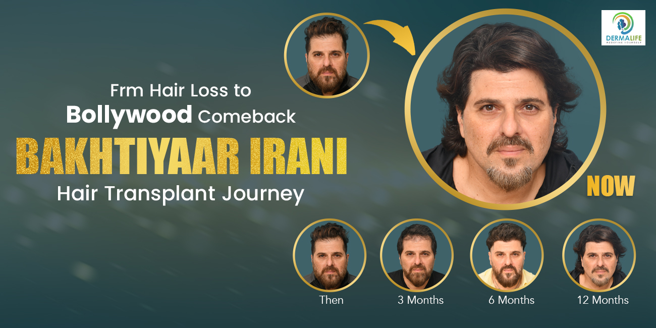 Bakhtiyar Iranis Hair Transplant Journey From Hair Loss to Bollywood Comeback