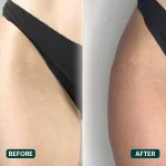 Body-Fillers