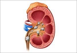 Can kidney stone removal surgery in Dubai improve kidney function