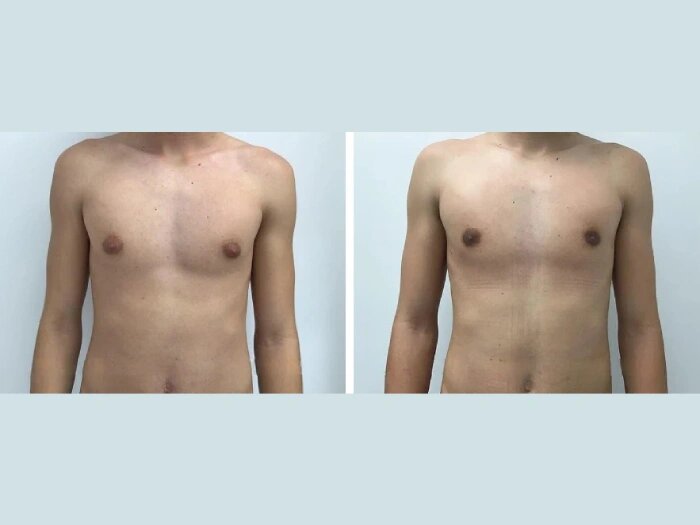 gynecomastia surgery in dubai