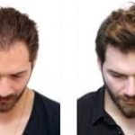 Hair transplant in Dubai (2)
