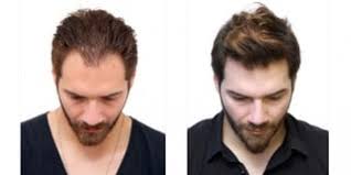Hair transplant in Dubai (2)