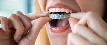 Invisalign Dentist Timonium