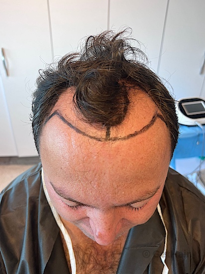 Is hair transplant cost worth it