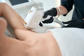 Laser Hair Removal 3