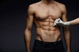 Liposuction surgery