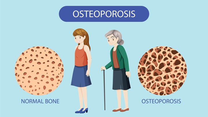 Osteoarthritis vs Osteoporosis What’s the Real Difference