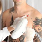 Laser Tattoo Removal in Dubai