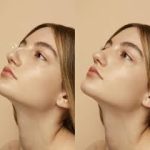 Rhinoplasty in Dubai 1