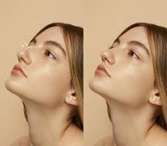 Rhinoplasty in Dubai 1