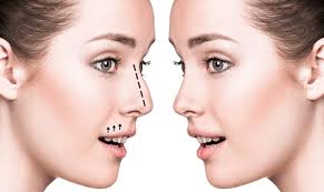 Rhinoplasty in Dubai 2