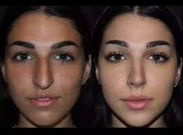 Rhinoplasty in Dubai 3