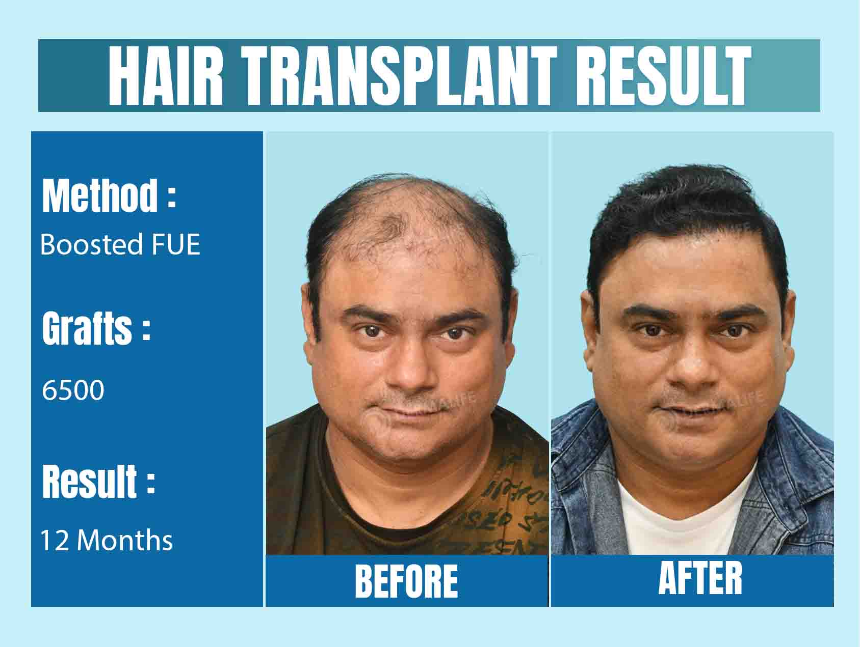 best celebrity hair transplant doctors in india