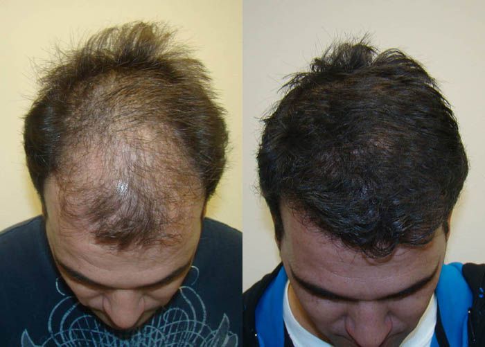 fue-hair-transplant-in-islamabad