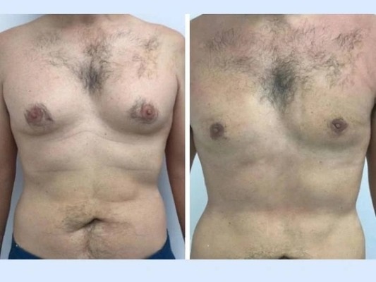 gynecomastia in dubai (1) (1) (1) (1)