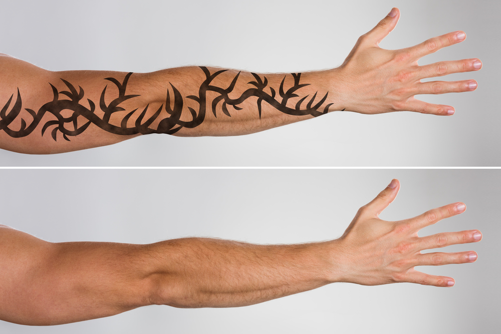 Laser Tattoo Removal in Dubai