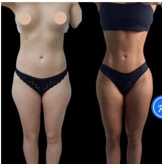 Tighten, Lift & Define with J-Plasma Skin Tightening Treatment in Dubai