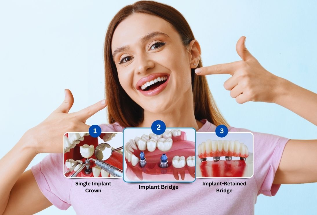 what-are-the-3-types-of-dental-implants