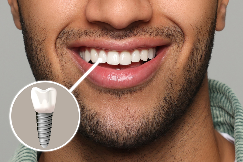 Dental Implants in Dubai