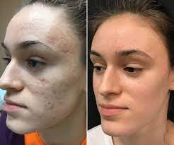 Can Acne Scar Treatments in Dubai Be Combined With Fillers