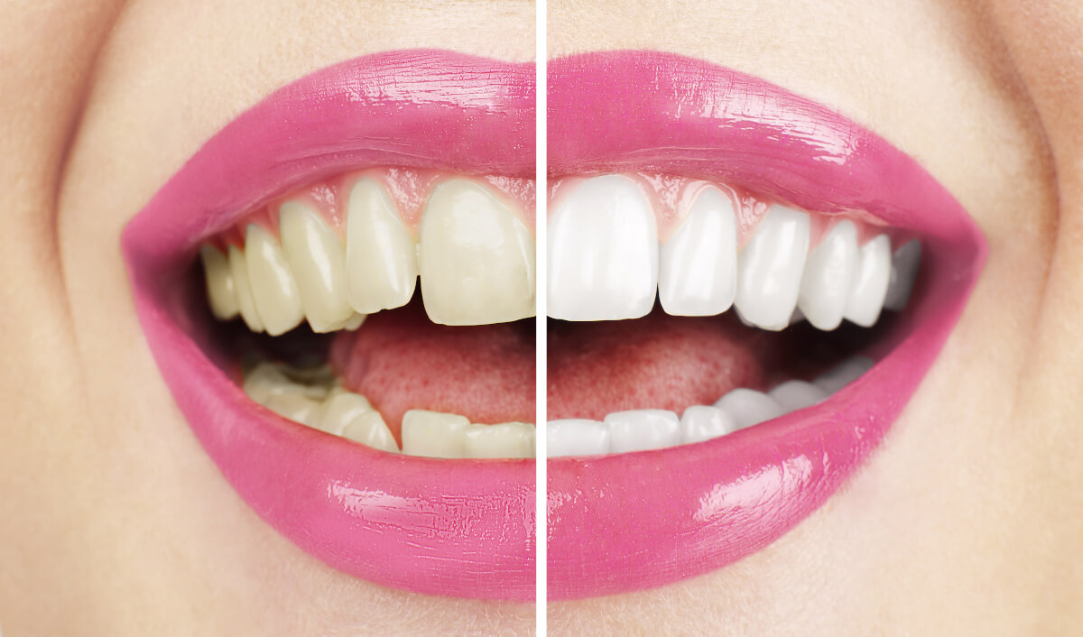Can Teeth Whitening Help Cover Up Smoking Stains