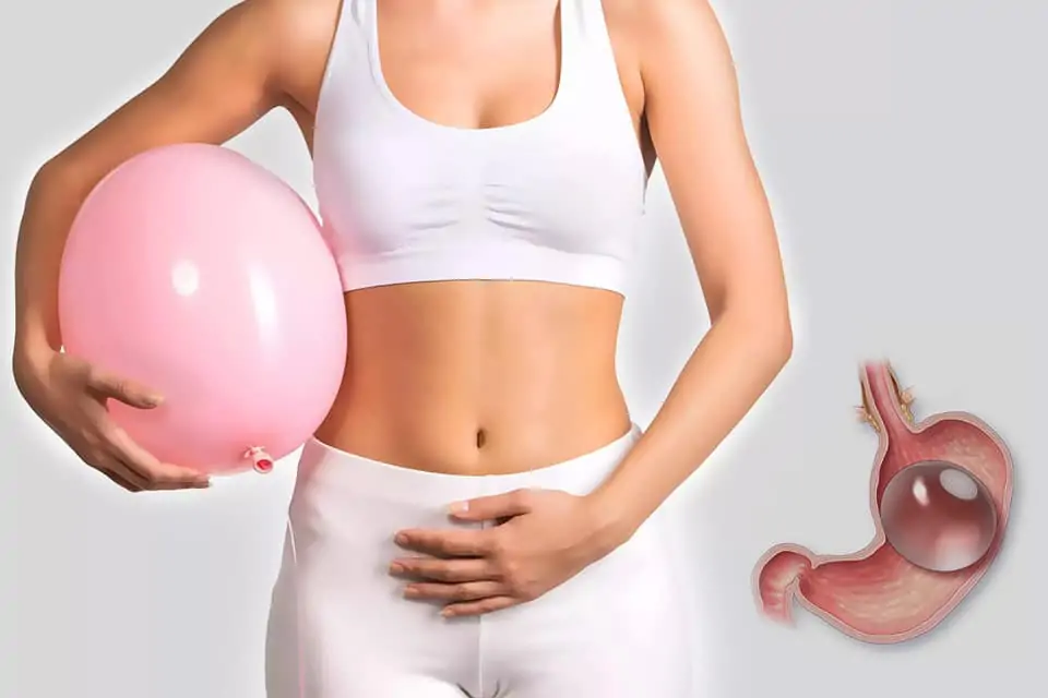 Can a gastric balloon in Dubai prevent the need for future bariatric surgery