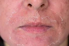 Chemical peeling in Dubai, Chemical peeling, best Chemical peeling in Dubai