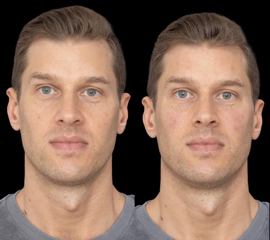 H2-Under-eye-fillers gallery (2)