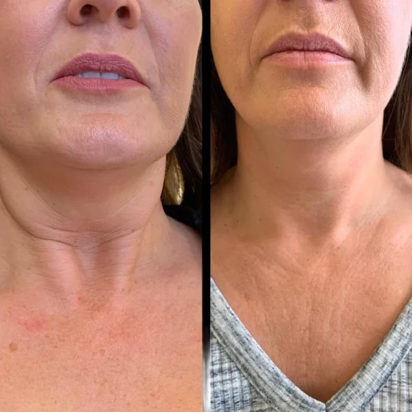 Profhilo treatments in dubai